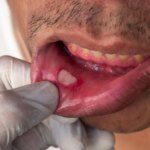 Remèdes naturels pour traiter et apaiser les aphtes