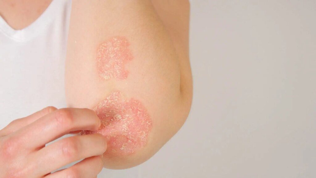 Les bienfaits de la pensée sauvage pour l'eczéma Les bienfaits de la pensée sauvage pour l'eczéma