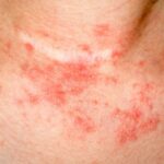 Les 4 meilleurs ingrédients naturels pour combattre l'eczéma