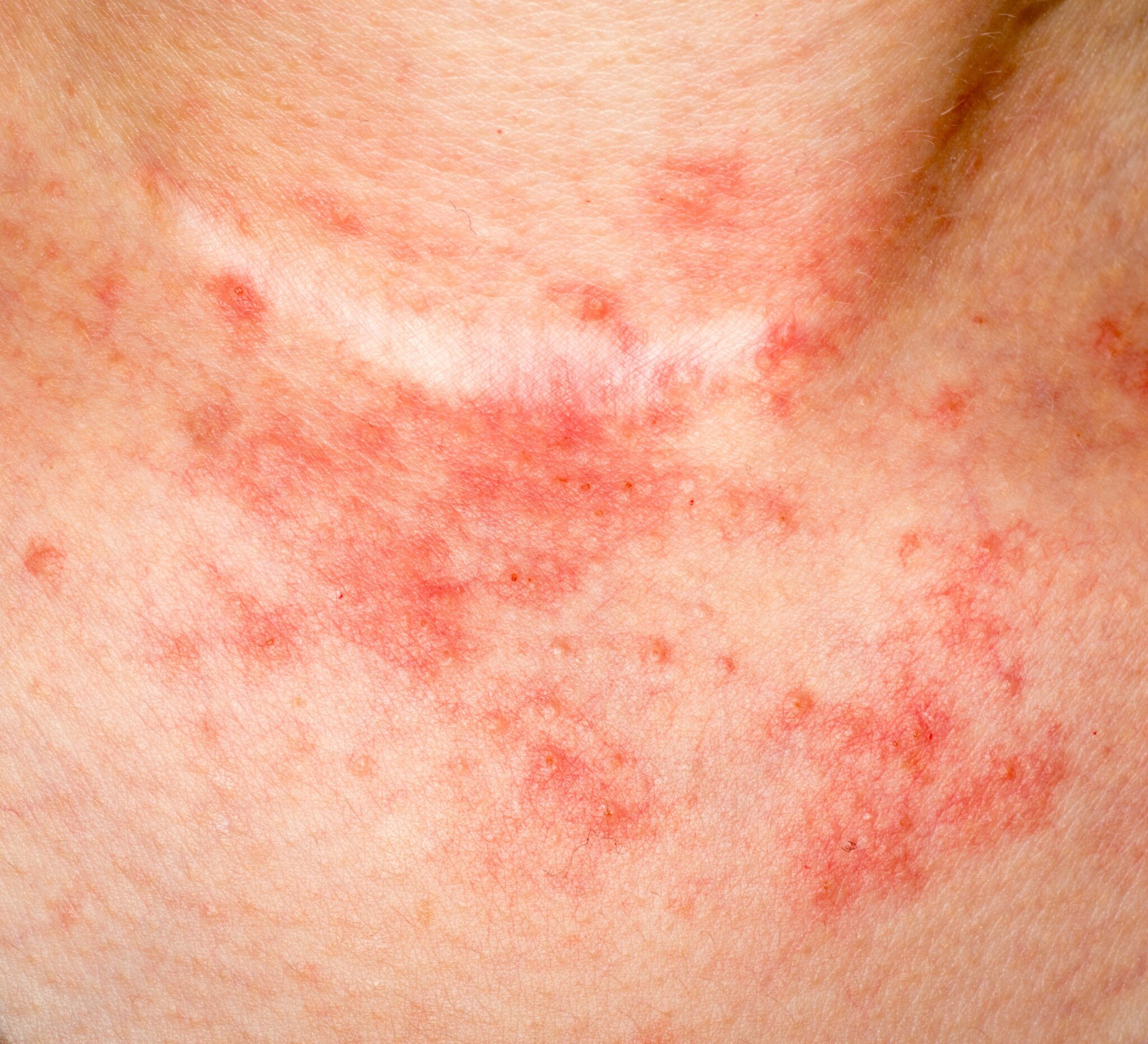 Les 4 meilleurs ingrédients naturels pour combattre l'eczéma