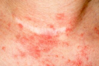 Les 4 meilleurs ingrédients naturels pour combattre l'eczéma