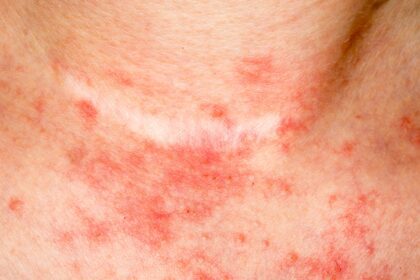 Les 4 meilleurs ingrédients naturels pour combattre l'eczéma